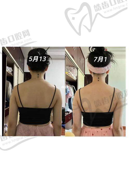 理性提醒：富贵包吸脂不是