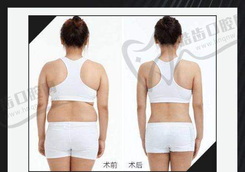 富贵包吸脂价格受哪些关键因素影响？（看完不花冤枉钱）