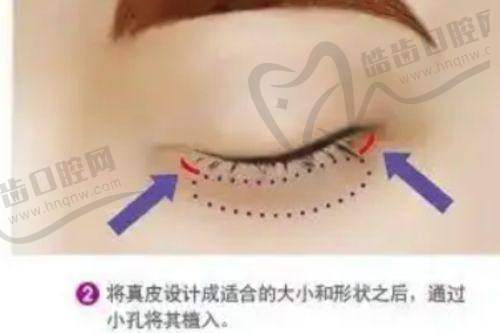 李花停注射价格多少？面部年轻化15000-25000元，懂熟龄肌调剂量