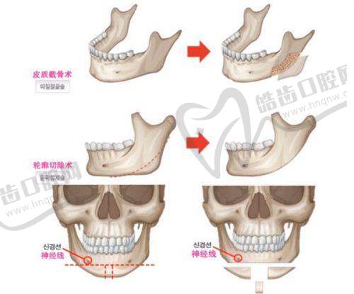如何看待李花停注射价格