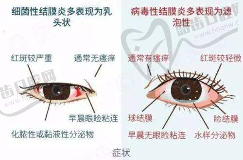 2000度的近视可以做手术吗——广州爱尔眼科的手术方案