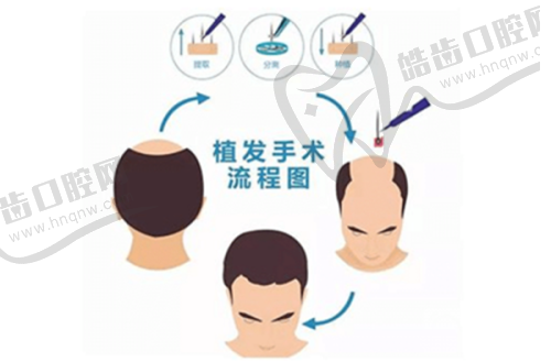苏州亚植植发医院特色项目及技术优势
