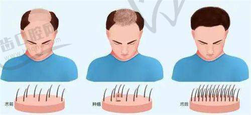 苏州亚植植发医院真人口碑评价怎么样？