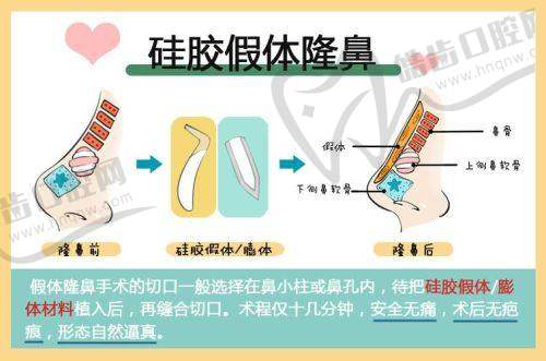 广州韩后王春华做鼻子怎么样？审美技术双优，打造自然妈生鼻效果超惊艳！ 