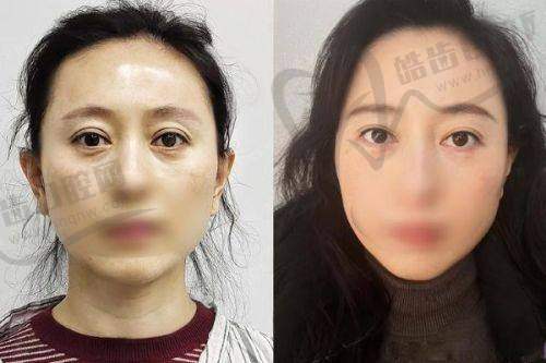 上海刘平医生眼鼻修复技术稳的真实实例：从“疑难杂症”到“原生美”的蜕变