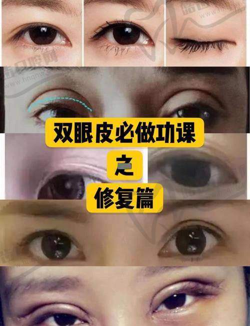 上海刘平医生眼鼻修复技术稳：四大核心优势铸就“修复盾牌”