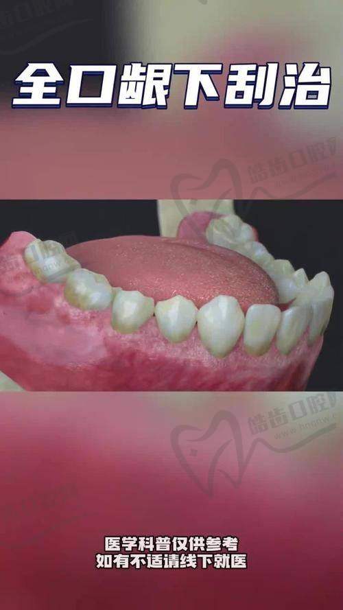 北京龈下刮治医院价格对比——北京中鸿口腔