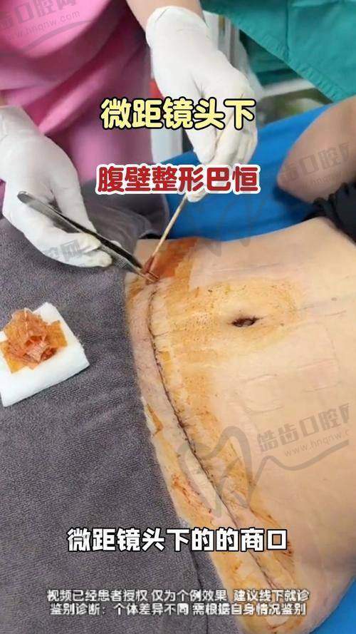 崔鑫医生腹壁整形预约攻略：四大方式助您快速预约