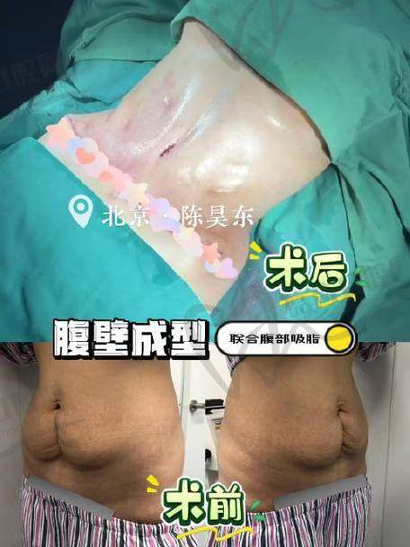 西安崔鑫医生腹壁整形手术的技术优势：三维复位与精细操作并重