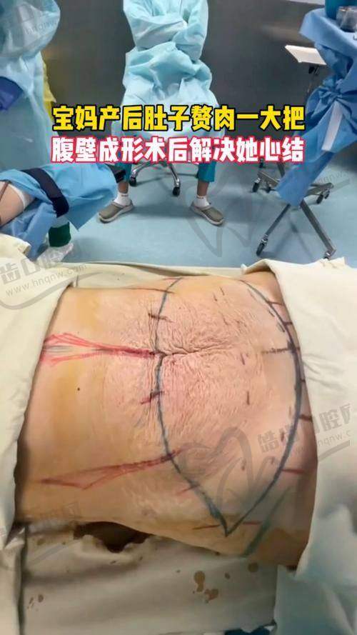 西安崔鑫医生腹壁整形手术的医院保护：四级资质与安心体系护航