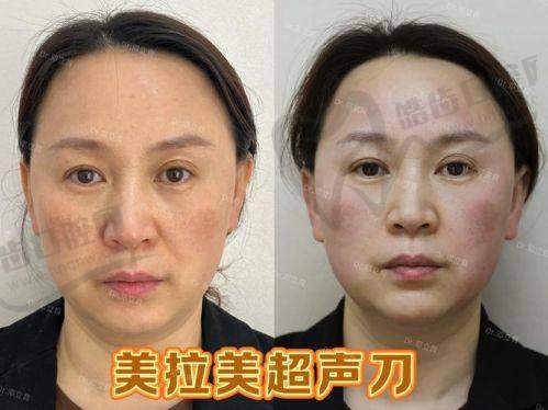 超声炮是如何实现面部提升和紧致肌肤成效的呢？