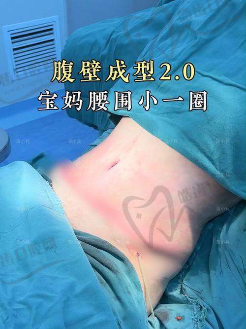 崔鑫医生腹壁整形费用及常见问题解答