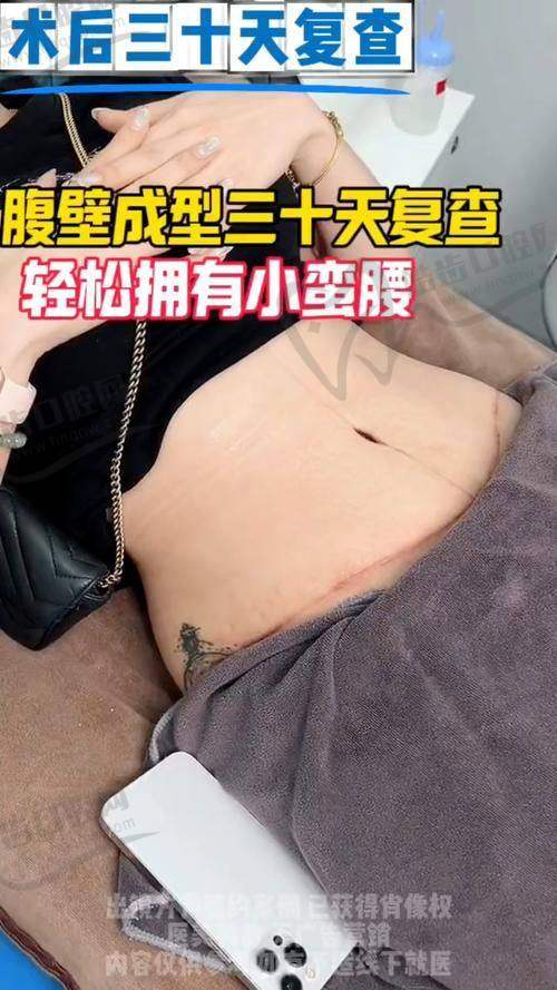 西安崔鑫医生腹壁整形手术的术后成效：动态修复与自然形态兼具