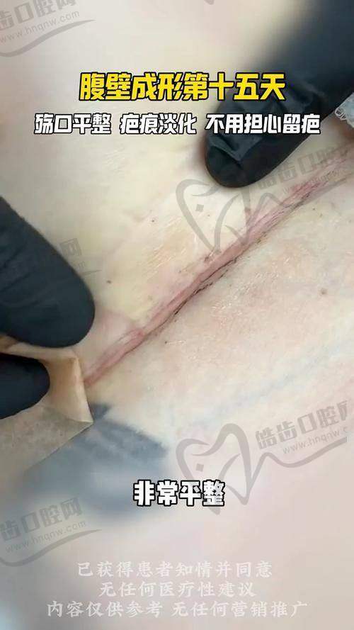 西安崔鑫医生腹壁整形手术的真实口碑：个性化方案与贴心服务获赞