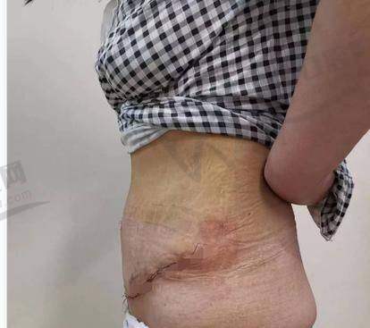 崔鑫医生腹壁整形技术特色：多项创新技术引领行业标准