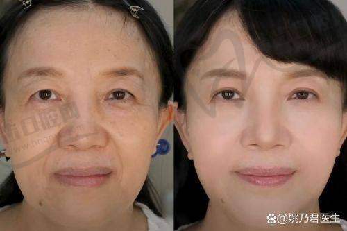 2025袁强博士大拉皮价格背后的价值保护
