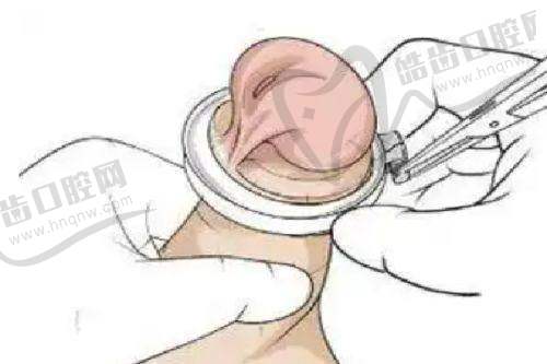 腰臀酷塑冷凍溶脂