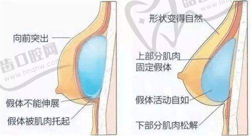 大腿酷塑冷凍溶脂