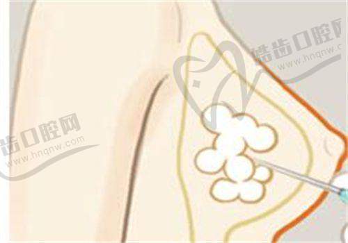 西安腺壁整形崔鑫怎么约之选择预约信息