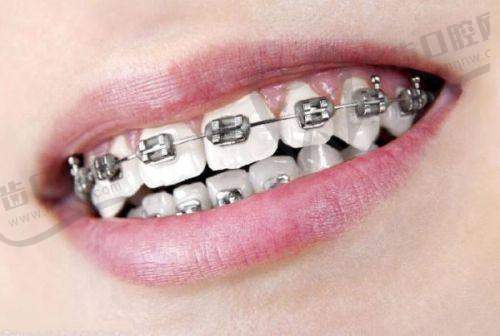 广州牙德堡口腔医院种植牙价格:综合优势凸显