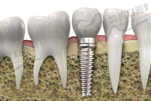 广州牙德堡口腔医院种植牙价格总结