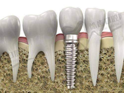 广州牙德堡口腔医院种植牙价格:精细化服务体验