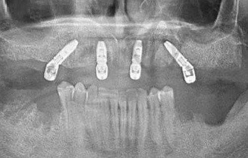 广州牙德堡口腔医院种植牙价格:技术优势降低风险