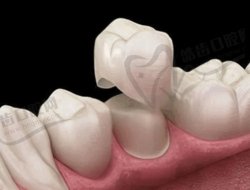 广州牙德堡口腔医院种植牙之口碑评价