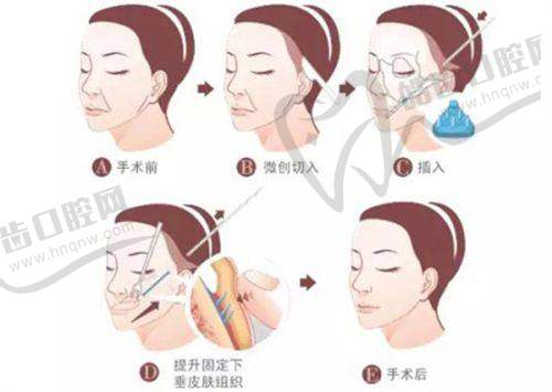 直击光微提升是什么？揭秘童颜光微提操作步骤