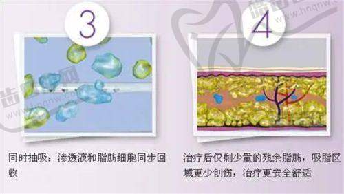 广州黄广香是哪家医院？——黄广香医生拉皮手术成效超棒