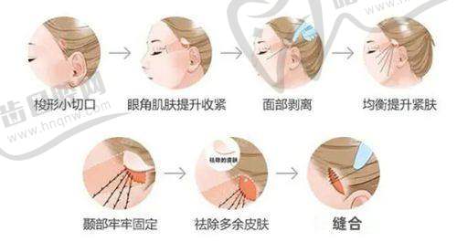 西安腺壁整形崔鑫医生之手术实例与口碑