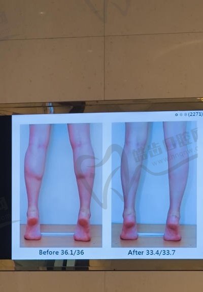 韩国sage瘦小腿