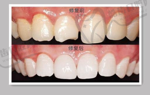广州牙德堡口腔陶瓷自锁矫正12000元起 王曼医生亲诊隐形正畸效果惊艳