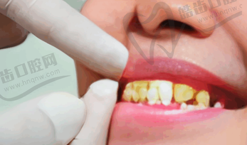 广州牙德堡口腔下颌正位智齿拔除480元起，5分钟无痛搞定，专业医生手稳技术强