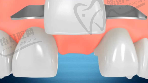 广州牙德堡口腔半固定半口种植牙种植牙2万元起，张兴博士亲诊即刻负重，告别缺牙烦恼！