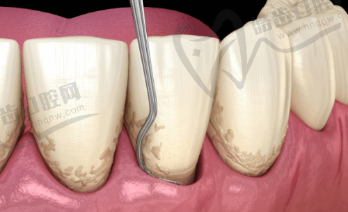 广州牙德堡口腔3M-z350树脂补牙仅需300元起，抗压耐磨持久美观，拯救你的蛀牙危机！