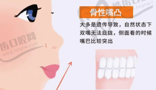 广州牙德堡王曼医生时代天使KID儿童矫正11000元起，4岁起告别龅牙地包天！