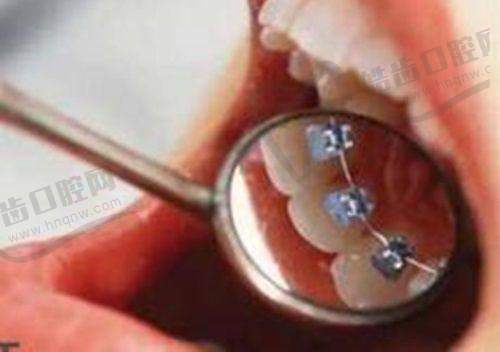 广州牙德堡口腔数字化固定义齿5000元起，3D定制舒适贴合，张兴医生团队专攻疑难修复