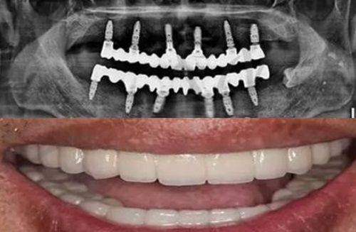广州牙德堡口腔半口活动义齿6000元起，夜间接诊至21点，社区惠民价更划算