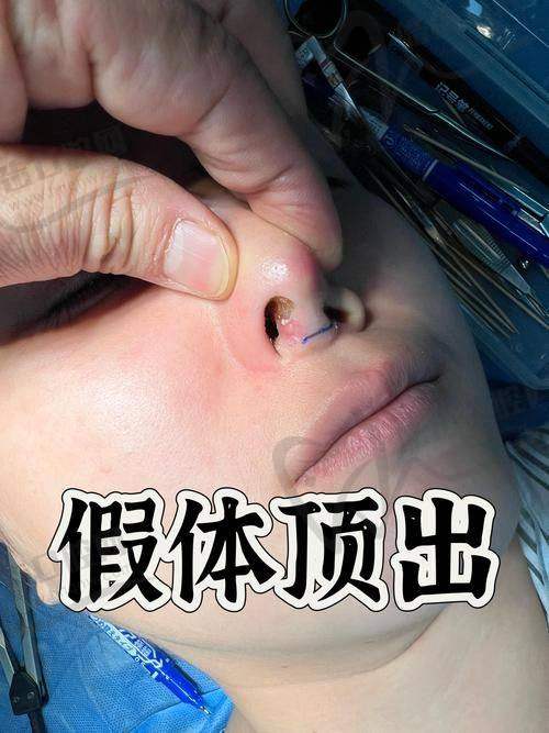 深圳郭世伟和刘冰谁更厉害？刘冰精于“鲁班精雕鼻”，郭世伟隆鼻痛感低恢复快 