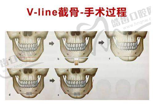 成都莊建波醫(yī)生處自體脂肪隆胸體驗