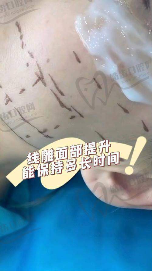 醫(yī)院面部小切口提升手術(shù)價(jià)格陷阱