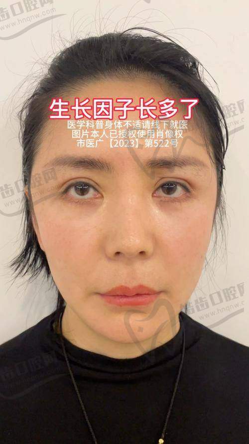 上海吴贞跃医生馒化脸效果好吗？特色修复技术与丰富案例给你真实反馈