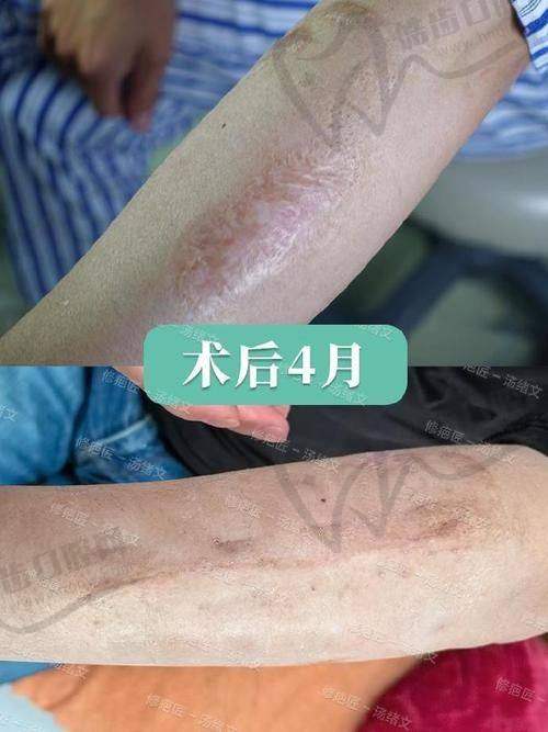 醫(yī)院面部小切口提升手術(shù)成效不持久問(wèn)題