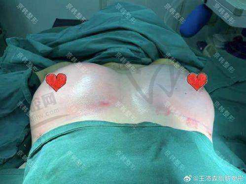 南京美貝爾黃名斗院長處自體脂肪隆胸體驗