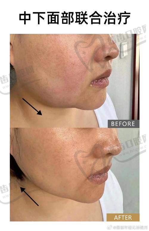 吴贞跃去馒化收费标准：全脸修复费用参考表