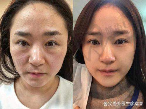 真实实例来了！她们都在吴贞跃这儿“从馒到妈生脸”