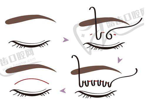 术后服务是怎样的？李燕医生的“强迫症式护理”令人安心