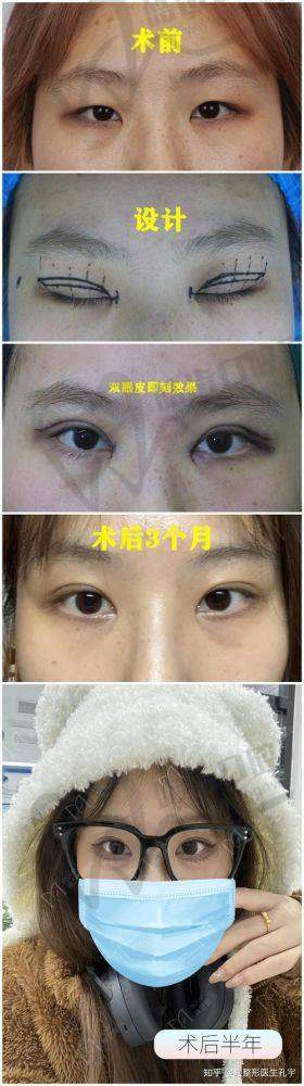 李燕医生主打技术：“显微5层复位术+睑缘切口术”双管齐下