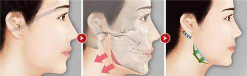 美波婷医疗美容医院:械三胶原蛋白的具有影响力认证与安心保护